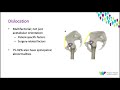 OrthoFracs Hip-spine relationship in total hip arthroplasty by Dr. Karen Bourns