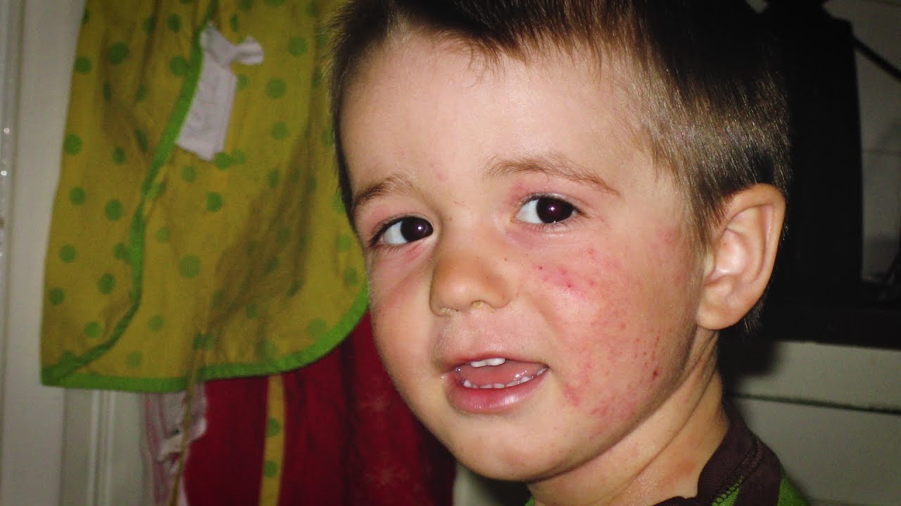 Leva med atopiskt eksem – ett familjeperspektiv