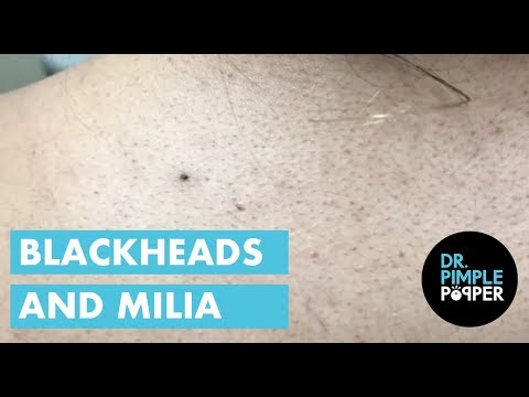 Blackheads & Milia With Dr Pimple Popper