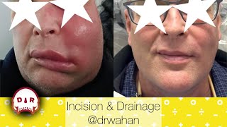 Incision and Drainage of Facial Abscess with Drain Placement @drwahan