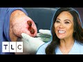 Dr lee removes an open wounded lipoma  dr pimple popper pop ups