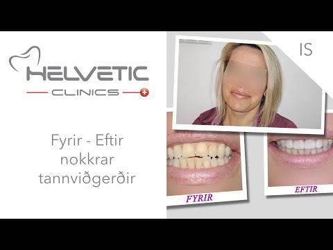 Fyrir - Eftir nokkrar tannviðgerðir