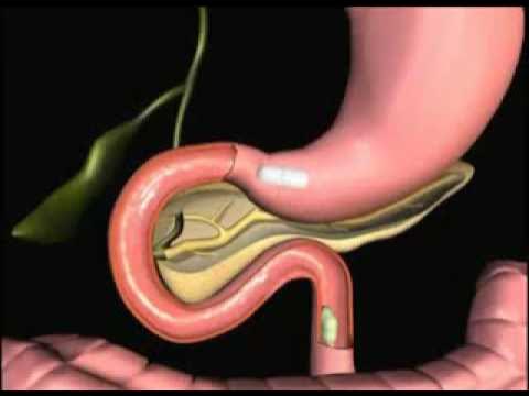 Синдром золлингера-эллисона. Синдром здоленгира елечмнв. Синдром золлингера-эллисона что это такое симптомы. Синдром желудочной гиперсекреции. Золинген синдром золлингера эллисона.