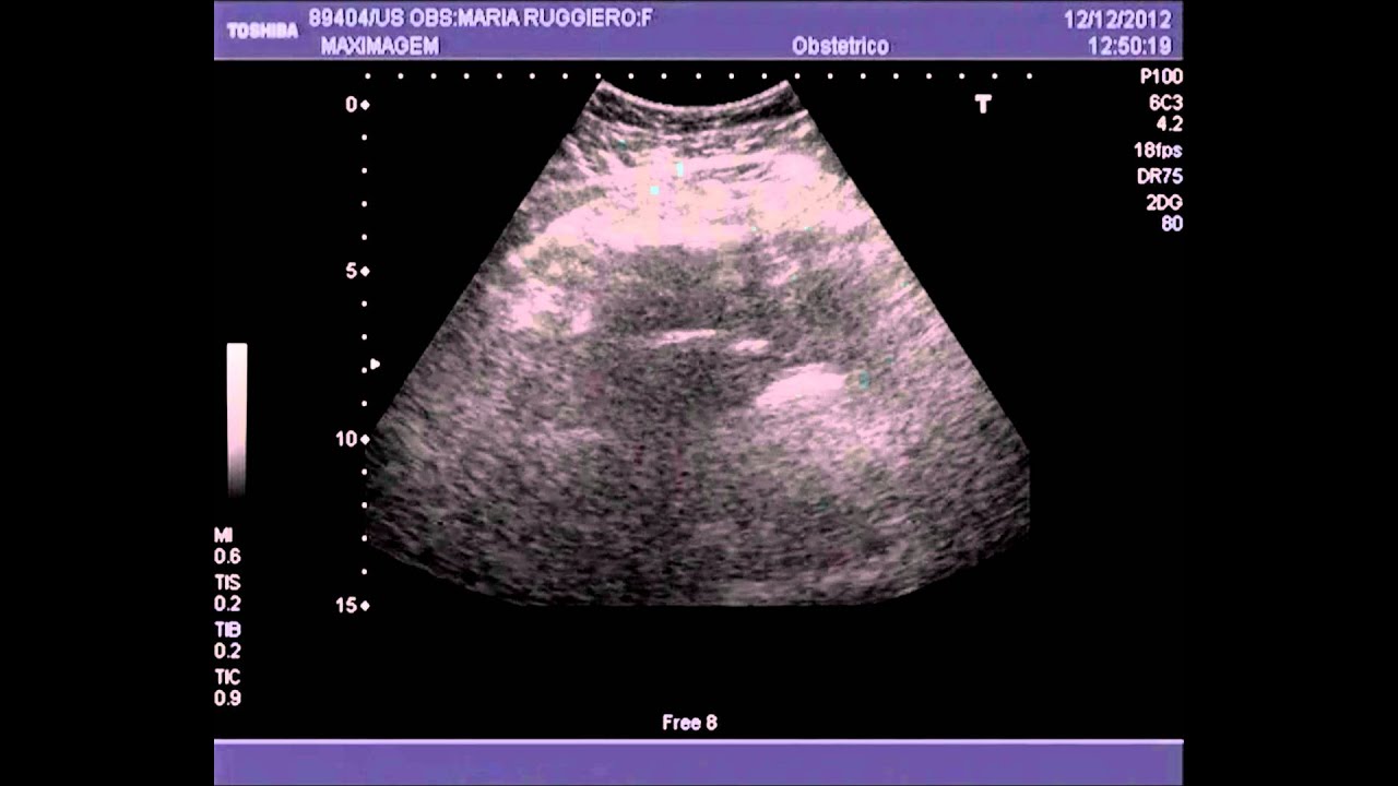 Mary Ruggiero 1º Ultrasom Mary Ruggiero - YouTube
