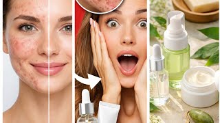 Acne Types &amp; Solutions: What to Use and When