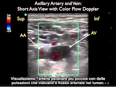 Video: Arteria Succlavia - Struttura, Stenosi, Trattamento