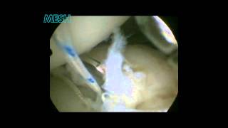 Posterior Bankart Repair
