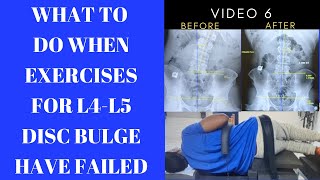 What to do When Exercises for L4-L5 Disc Bulge Have Failed | Dr. Greg Kramer Chiropractor Livonia Mi