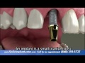 A Single Implant - Why replace missing teeth?