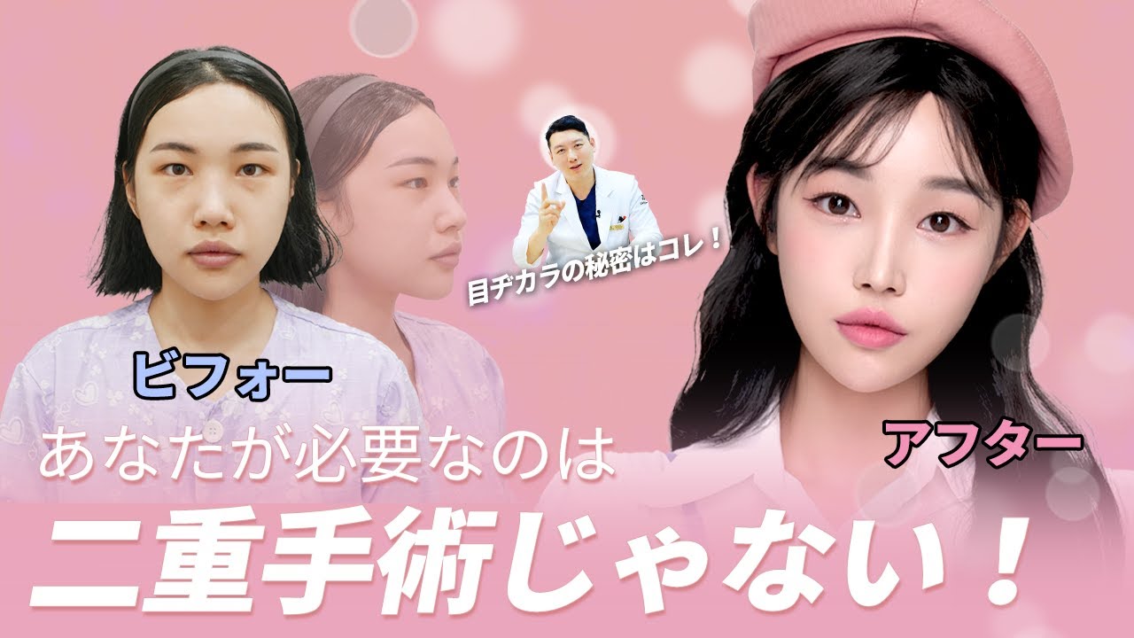 #額リフト #二重整形 #額リフトレビュー