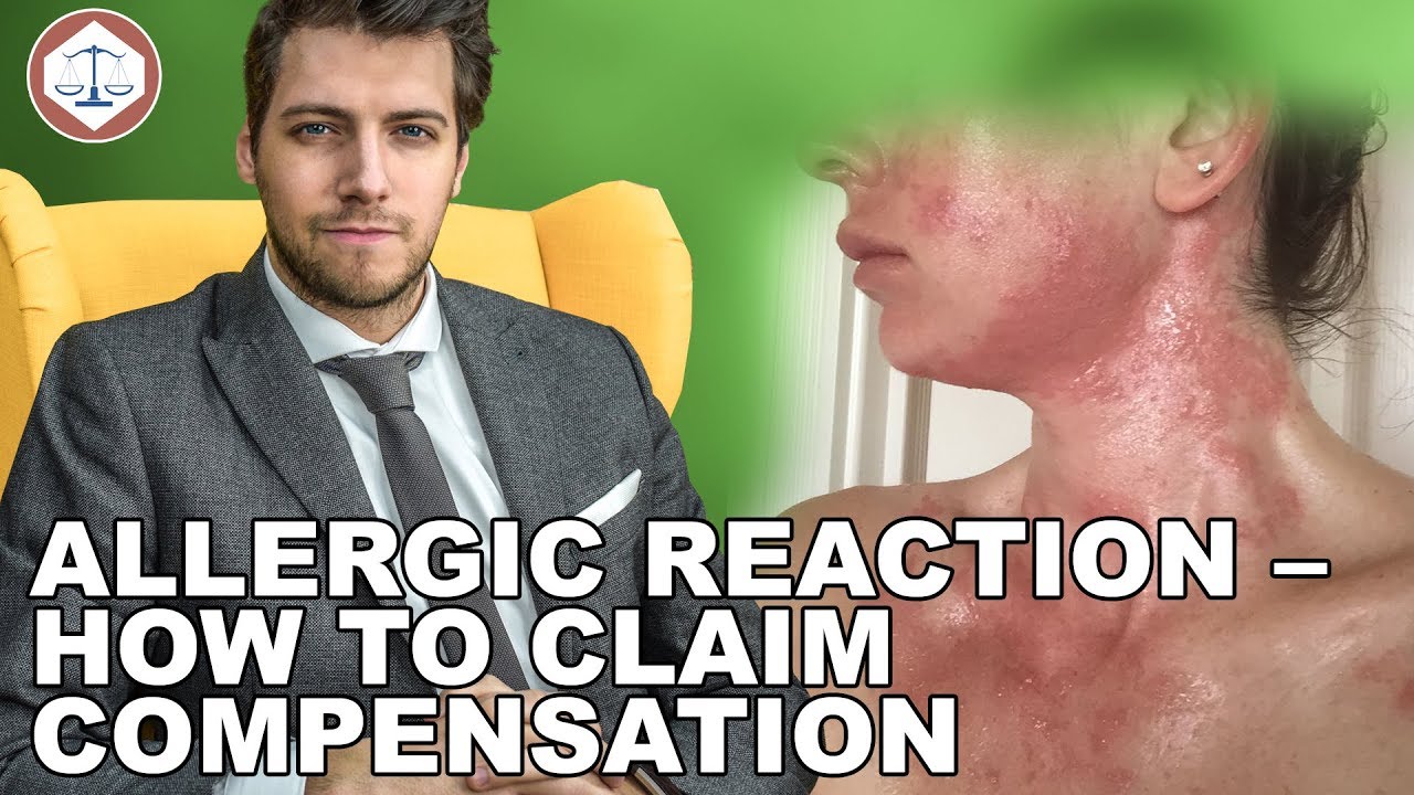 Allergic Reaction – How to Claim Compensation ( 2019 ) UK