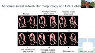 Imaging in Obstructive Hypertrophic Cardiomyopathy