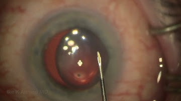 Xen Glaucoma Surgery: Ideal Subconjunctival Placement