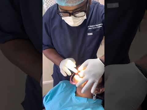 Dental veneers by Dr Eldhose Kulangara