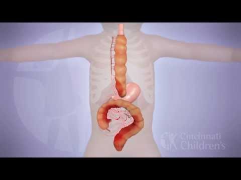 Long-Segment Colonic Interposition for Esophageal Atresia: 3D Animation