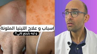 التينيا الملونة - الاسباب و العلاج - ليه بترجع تاني؟!