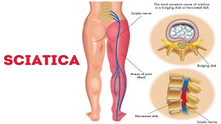 SCIATICA, 6 CARA PHYSIO TERBAIK untuk cepat sembuh | Dr. Noordin Darus