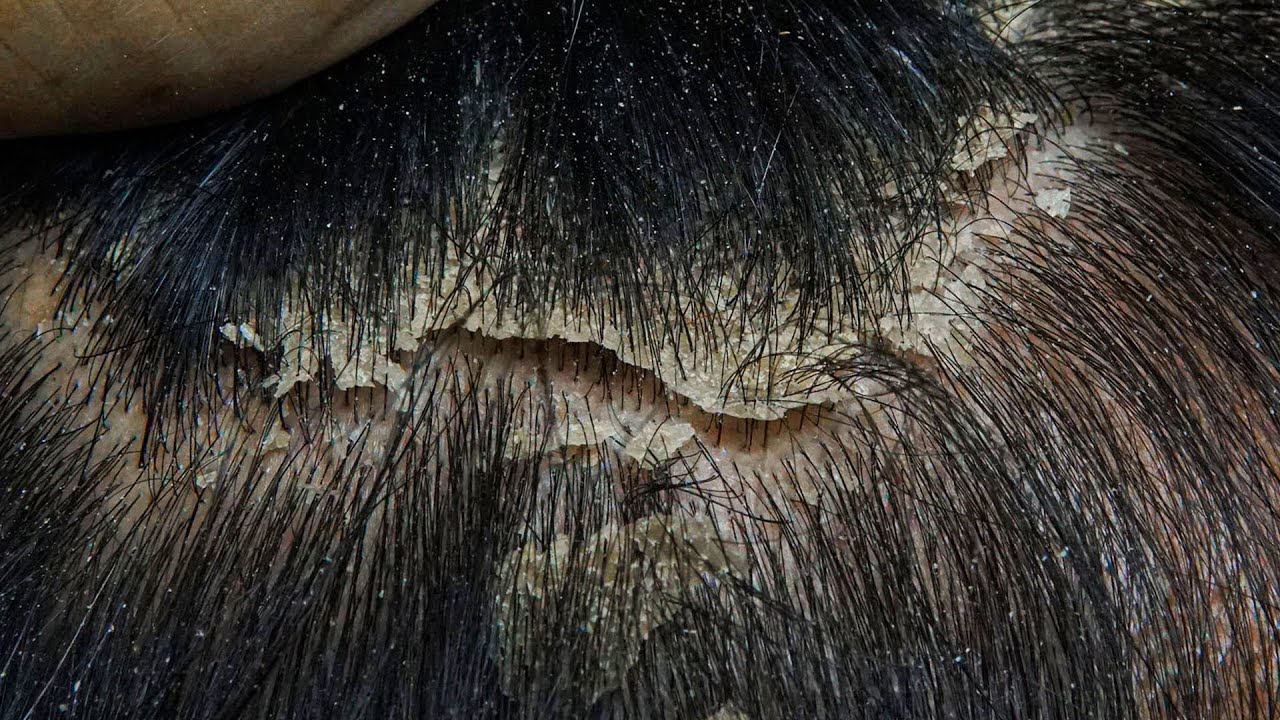 ASMR Satisfying Dandruff & Scalp Flakes Removal | Deep Comb Scratching 
