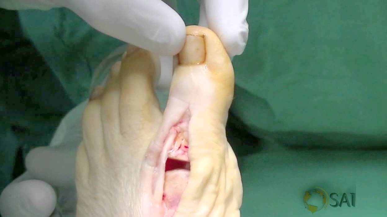 South America Implants S.A. - Hallux Connection - Cirugía Hemiartroplastía de Hallux