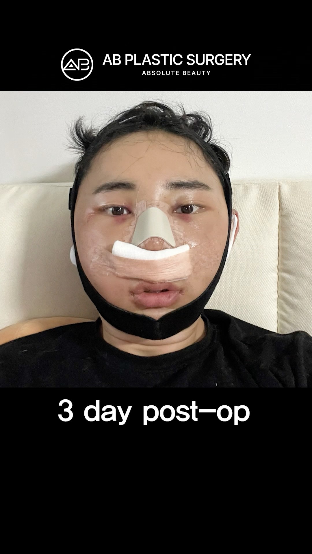 My Rhinoplasty Journey! Male Nose Job Before & After! #koreanplasticsurgery