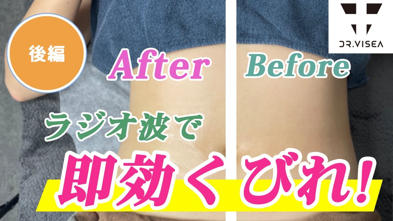 ラジオ波エステ☆ハイパーウェーブプレミアム☆痩身 たるみ 引き締め ラジオ波エステ☆ハイパーウェーブプレミアム☆痩身 たるみ 引き締め