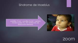 NEUROOFTALMO, PARALISIS DEL II, IV Y VI PAR CRANEAL