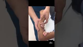 Réduction Dune Fracture De Lavant Bras