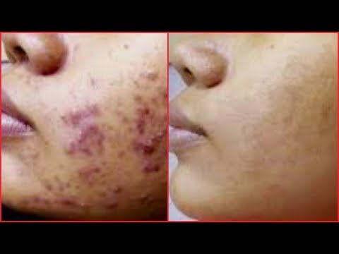  ACNE REMEDIES, GET RID OF ACNE, PIMPLES AND ACNE SCARS FAST |Khichi Beauty