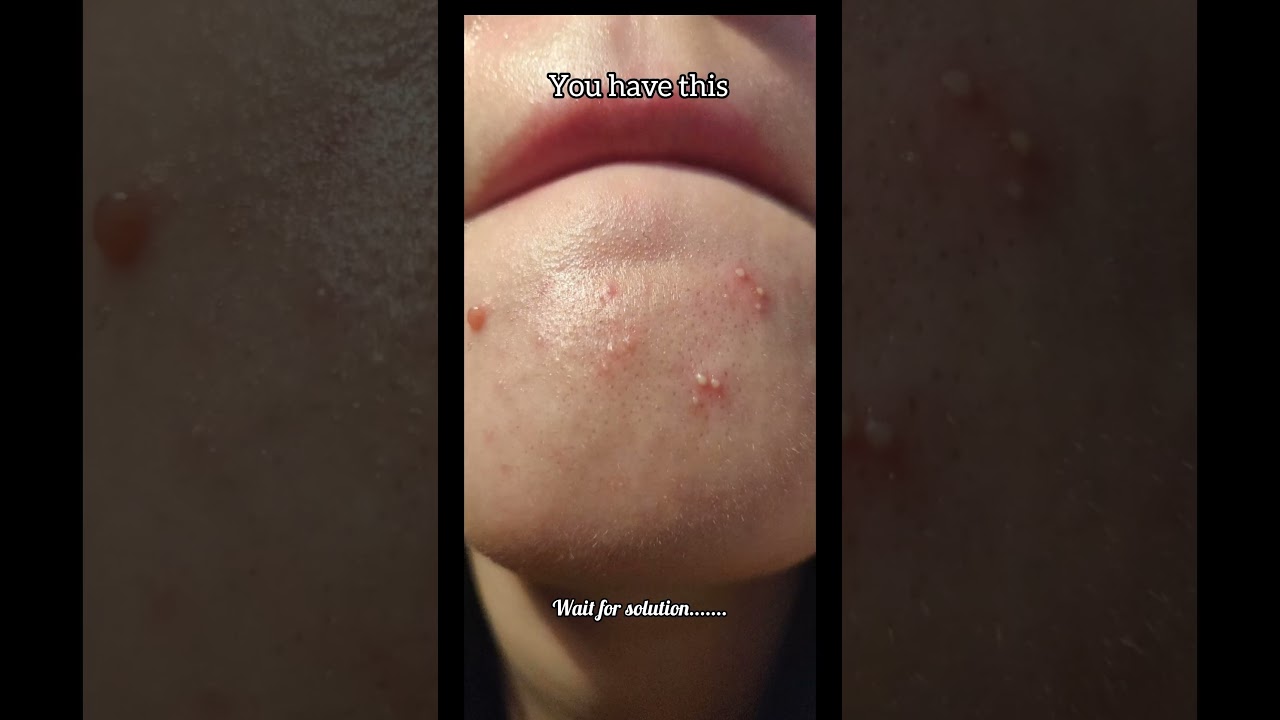 CeraVe Blemish Control Cleanser 💦 Unclogs pores & removes blemishes.