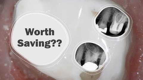 Broken Down Molar Root Canal