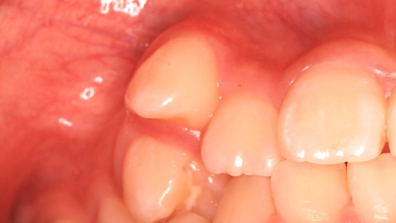 Non-extraction orthodontic treatment for canines that have completely erupted out of the dentition