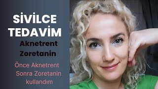 Zoretanin, Aknetrent, Zoretanin Tedavisi, Aknetrent Tedavisi, Akne Tedavisi, Solante Acnes,La Roche,