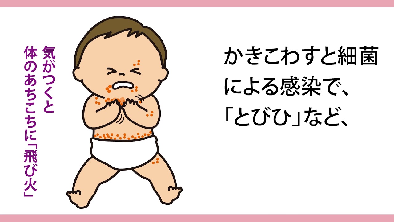 赤ちゃん 子どものあせも対策 Youtube