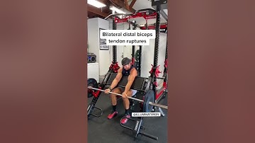 Bilateral Distal Biceps Tendon Rupture (RARE) #shorts