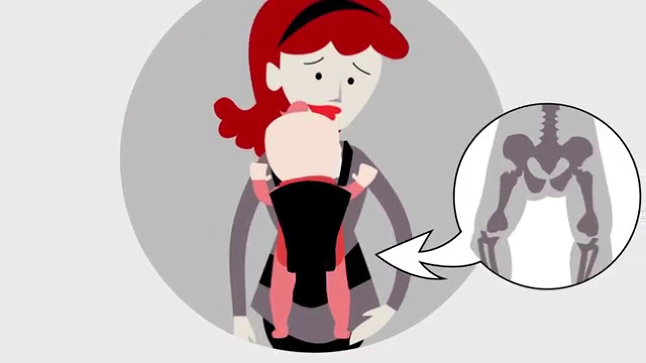 Come scegliere un marsupio, cos'e' la displasia alle anche del bambino,  marsupio Hipster - YouTube