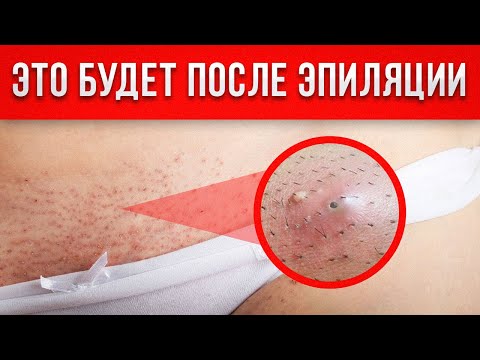 Это УБЬЕТ вашу КОЖУ! / Какие бывают ОСЛОЖНЕНИЯ после ЛАЗЕРНОЙ эпиляции?