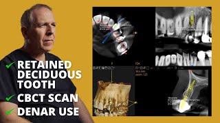Implant Planning using CBCT - Dentistry Case by Dominic Hassall Cbct Analysis For Regular Implant Cases