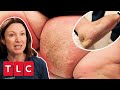 Dr Emma Helps Patient To &quot;Never Give Up&quot; On SEVERE Lymphoedema | The Bad Skin Clinic