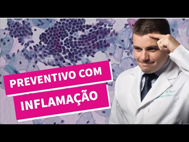 Pólipo endometrial: Dr. Rubens do Val responde! - Clínica Rubens do Val CRM  58764