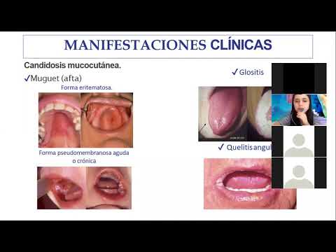 CANDIDIASIS, HERPES GENITAL Y DONOVANOSIS