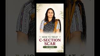 How to treat c-section scar in home #csection #diastasisrectiexercises #diastasisrecti