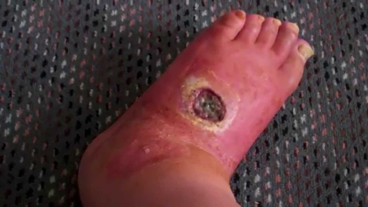 Images Of Brown Recluse Spider Bites On Humans