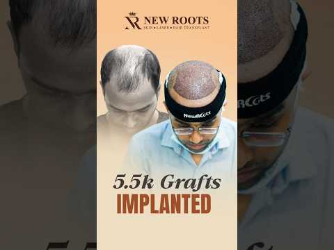 Real Hair Transplant Story | 5500 Grafts Hair Transplant in Siliguri #hairtransplant #siliguri