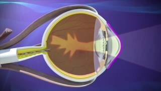 Astigmatism