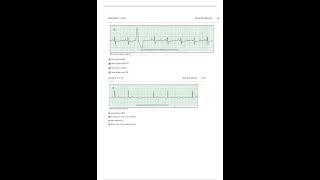 RELIAS DYSRHYTHMIA BASIC B 35 QUESTIONS WITH ANSWERS GRADED A+