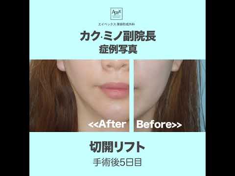 [Bệnh viện thẩm mỹ Apex] Phó giám đốc Kakuminonori Nori cắt mí_Trước và Sau