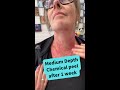 Medium Depth Chemical Peel at the dermatologist