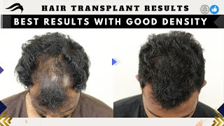 Hair Transplant In Mumbai | Best Surgeon Clinic Results & Cost Of Hair Transplant In Mumbai