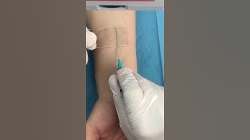 Vein vessel visualization device for hemodialysis and IV.