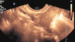 Sono HSG Procedure with ABBI showing fallopian tube patency